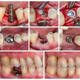 Dentaltech Healing Abutments Regular - Osstem | Dentium | DIO | Cowellmedi | Neobiotech | Dentis Compatible - 9