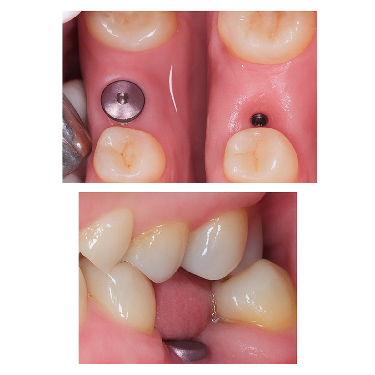 Dentaltech Healing Abutments - Straumann RC Implant Compatible