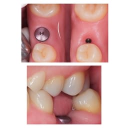 Dentaltech Healing Abutments - Straumann RC Implant Compatible - 8