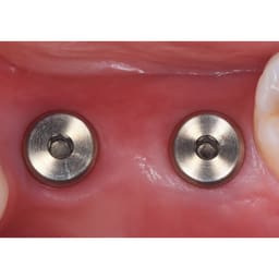 Dentaltech Healing Abutments - Nobel Biocare NP Implant Compatible - 7