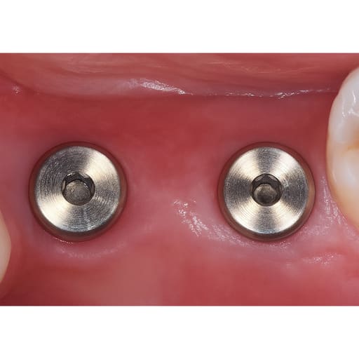 Dentaltech Healing Abutments - Nobel Biocare NP Implant Compatible