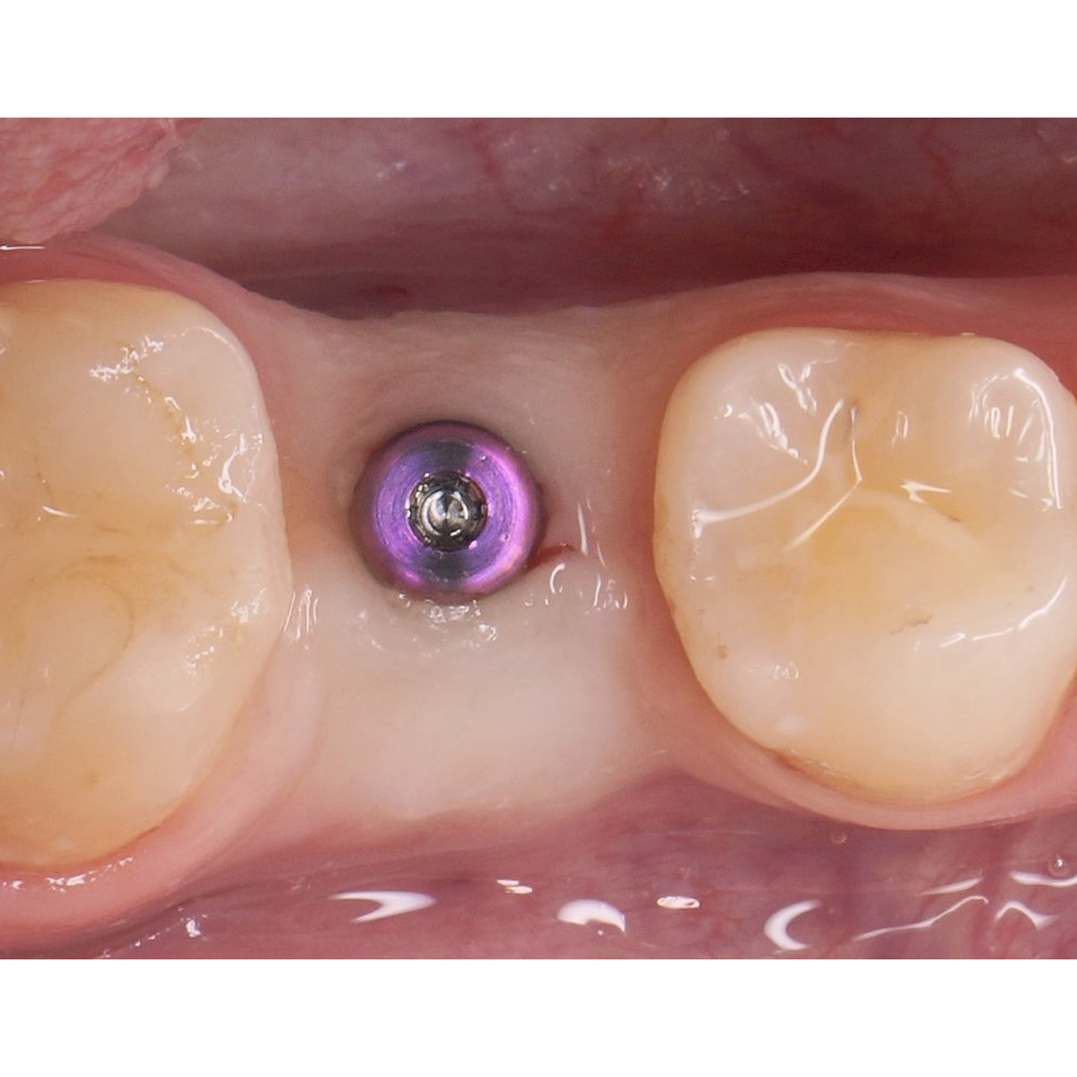 Dentaltech Healing Abutments - Straumann BLX Implant Compatible
