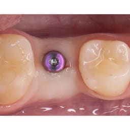 Dentaltech Healing Abutments - Straumann BLX Implant Compatible - 7