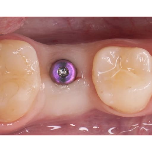 Dentaltech Healing Abutments - Straumann BLX Implant Compatible