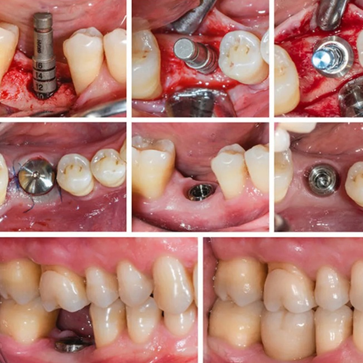 Dentaltech Healing Abutments - Nobel Biocare RP Implant Compatible