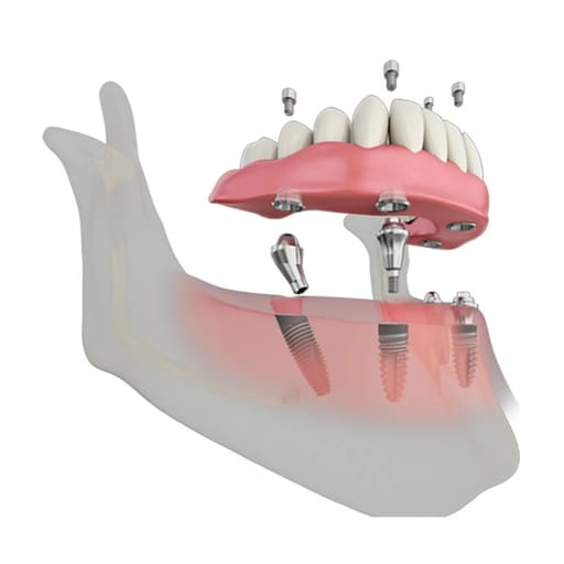 Dentaltech Multi Unit Angular Abutments RS - Adin | Noris | MIS | AB Dental Compatible