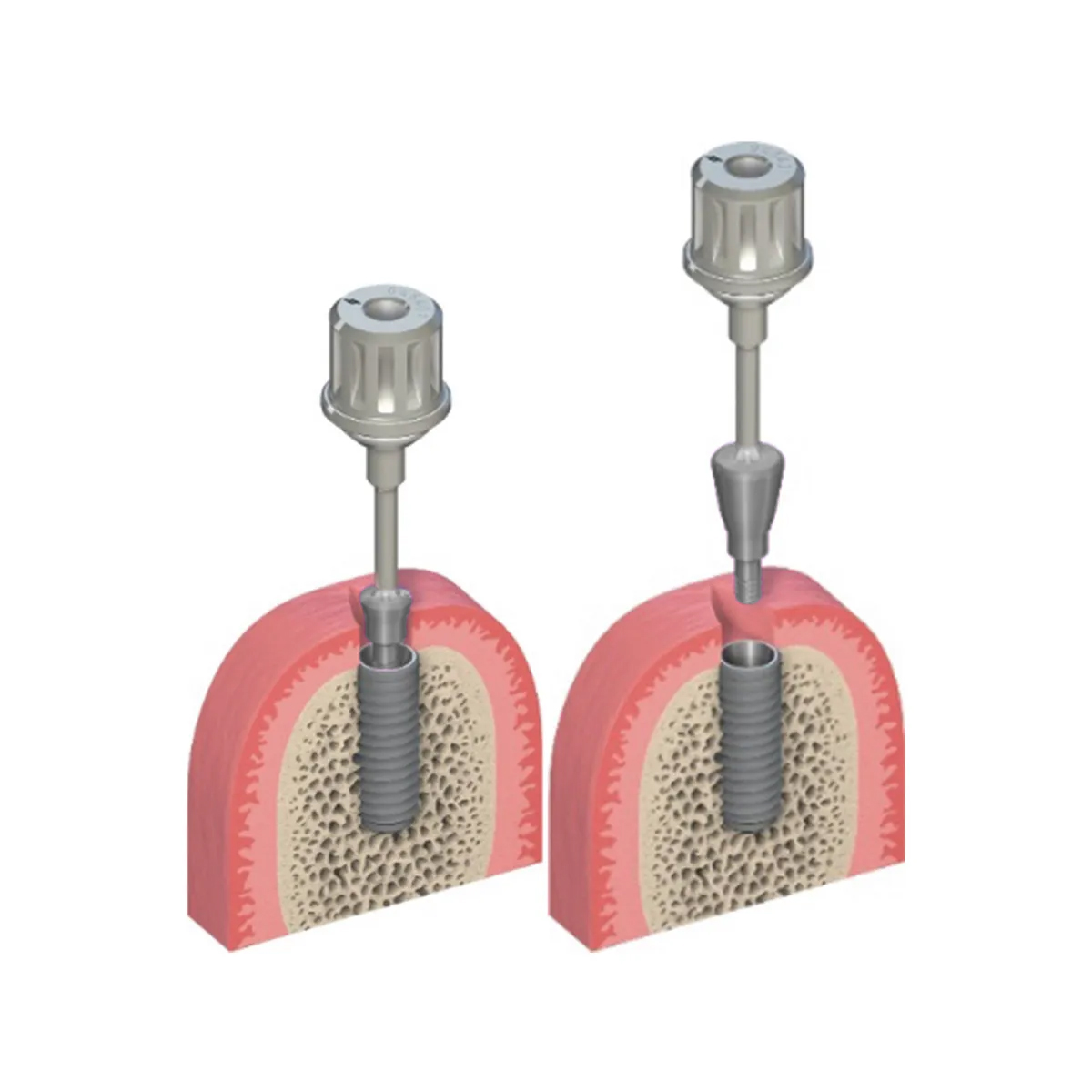 Dentaltech Healing Abutments - Straumann RC Implant Compatible