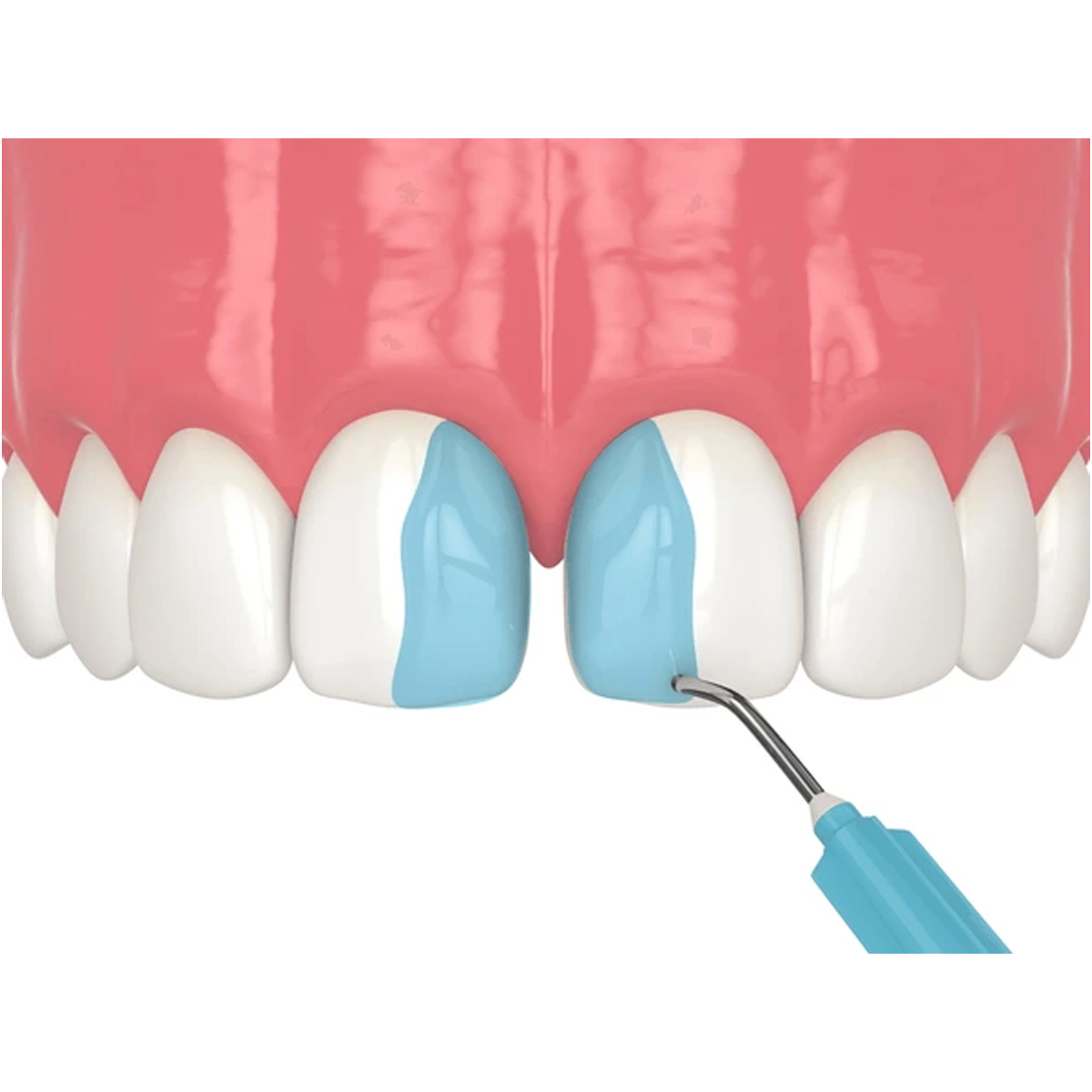 Ivoclar N-Etch Etching Gel