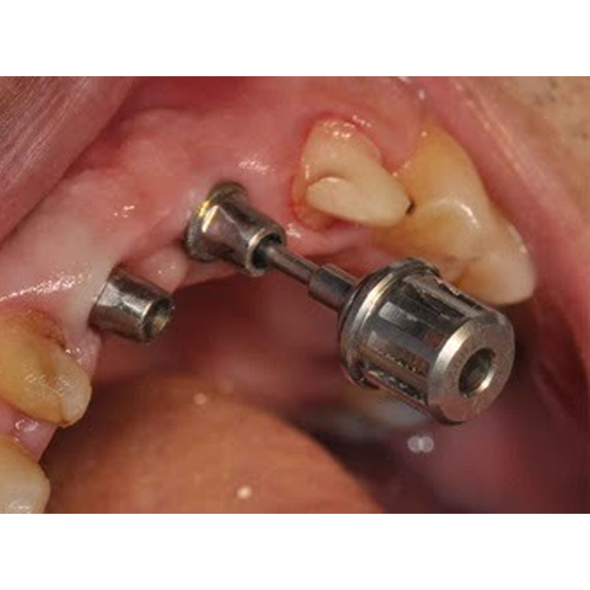 Dentaltech Straight Abutments RS - Adin | Noris | MIS | AB Dental Compatible