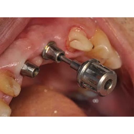Dentaltech Straight Abutments RS - Adin | Noris | MIS | AB Dental Compatible