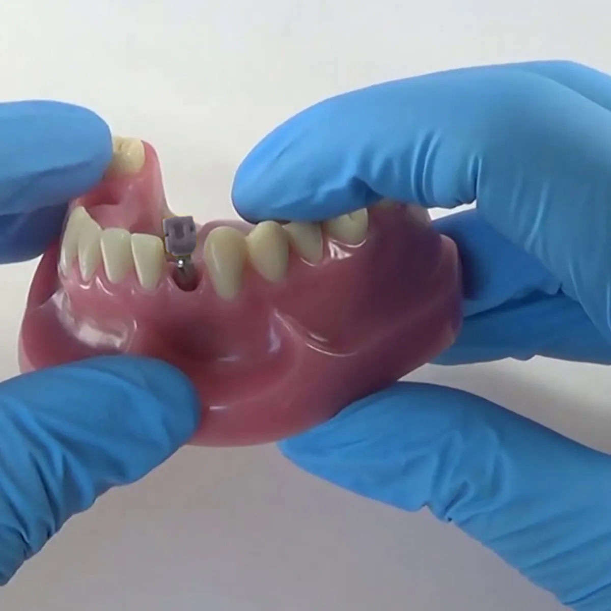 Dentaltech Close Tray Impression Coping ∅4mm - Straumann RC Implant Compatible (ITI-RC 025.4201)