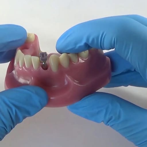 Dentaltech Close Tray Impression Coping ∅4mm - Straumann RC Implant Compatible (ITI-RC 025.4201)
