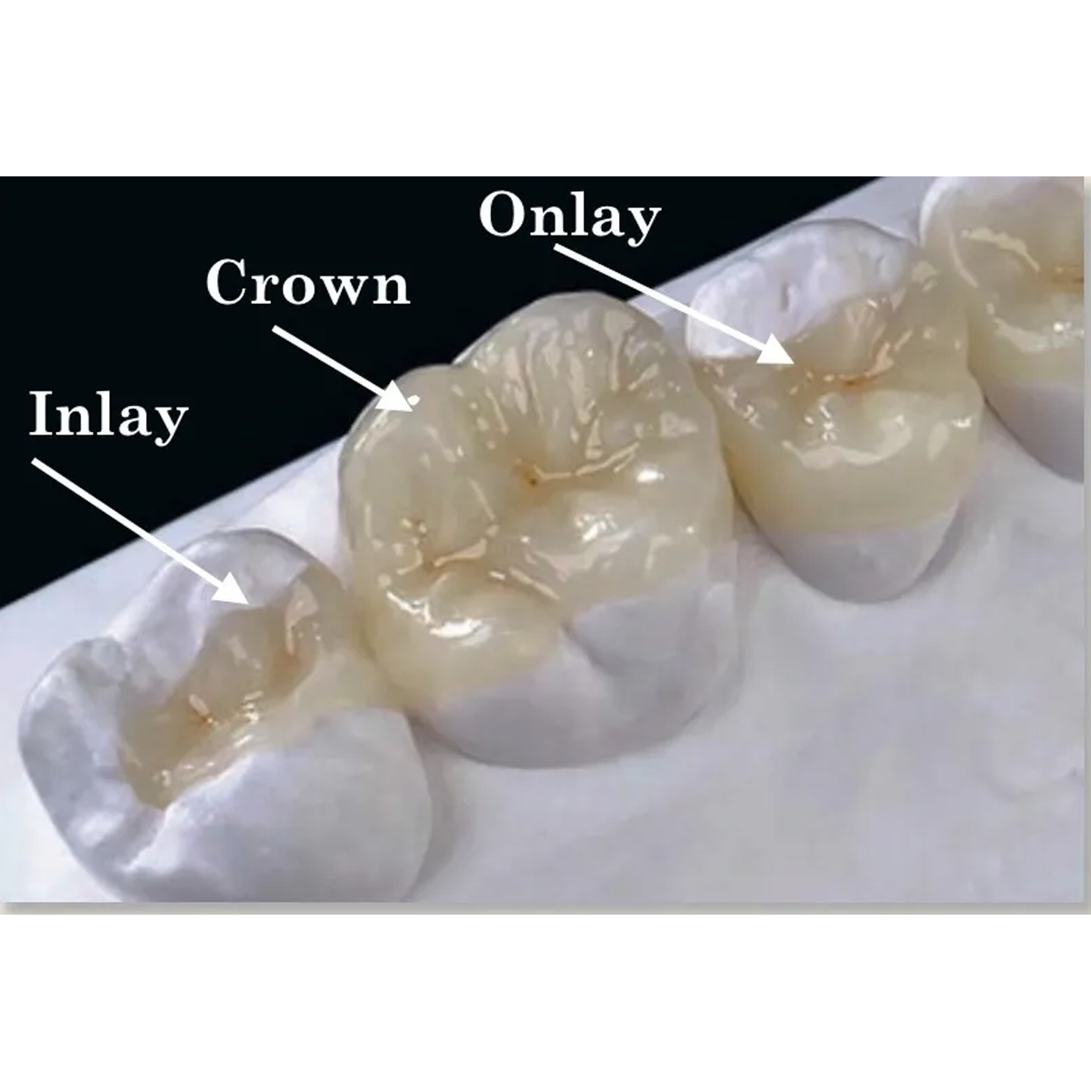 Ivoclar Telio Inlay / Onlay Temporary Filling Material - Universal (Pack Of 3)