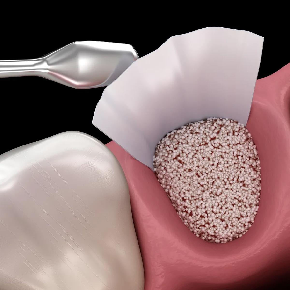 Fredna Freossi Granules Bone Graft Materials 0.5gm