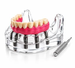 Julldent Overdenture Implant Model with 6 Implants (JULL-DENT 202) - 1