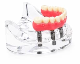 Julldent Overdenture Implant Model with 6 Implants (JULL-DENT 202) - 7