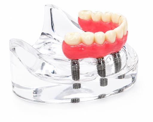 Julldent Overdenture Implant Model with 6 Implants (JULL-DENT 202)
