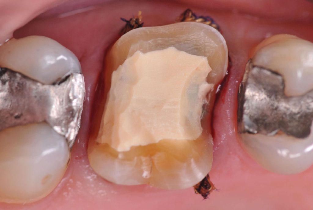 Septodont Biodentine Kit (Pack of 5 capsules) (Short Expiry 09-2026)