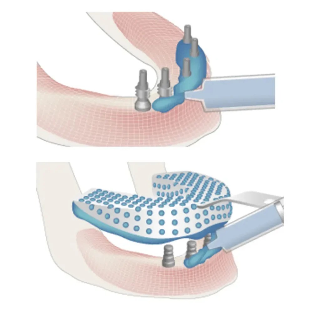 Dentaltech Impression Copings RS - Adin | Noris | MIS | AB Dental Compatible