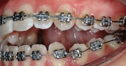 OrthoMetric Flexy NiTi Super Elastic Esthetic Rhodium Plated Archwires - Square (1/Pk) - 6