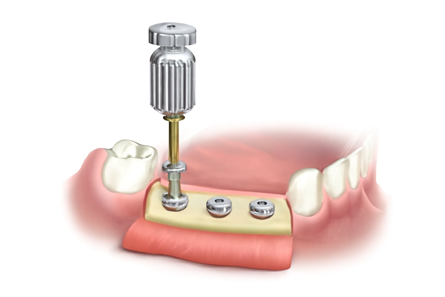 Dentaltech Implant Cover Screws - Osstem | Dentium | DIO | Cowellmedi | Neobiotech | Dentis Compatible