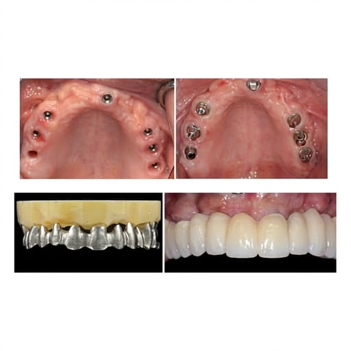 Dentaltech Multi Unit Straight Abutments RS - Adin | Noris | MIS | AB Dental Compatible