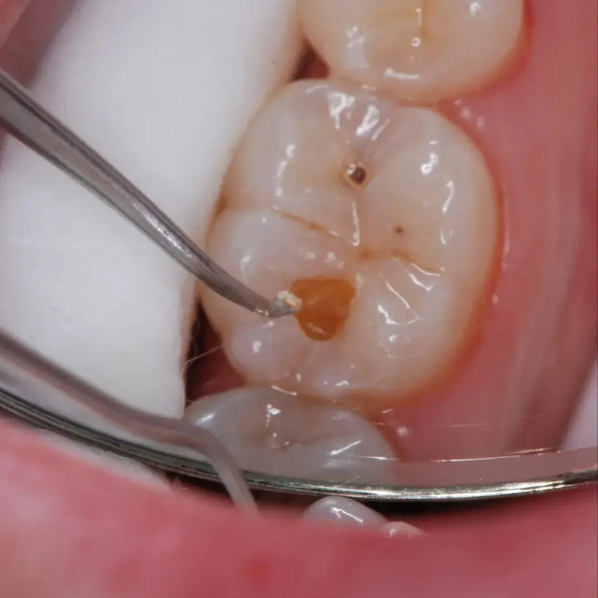 GDC ART Atraumatic Restorative Treatment Spoon Excavator 1mm (EXC133/134 # 6)