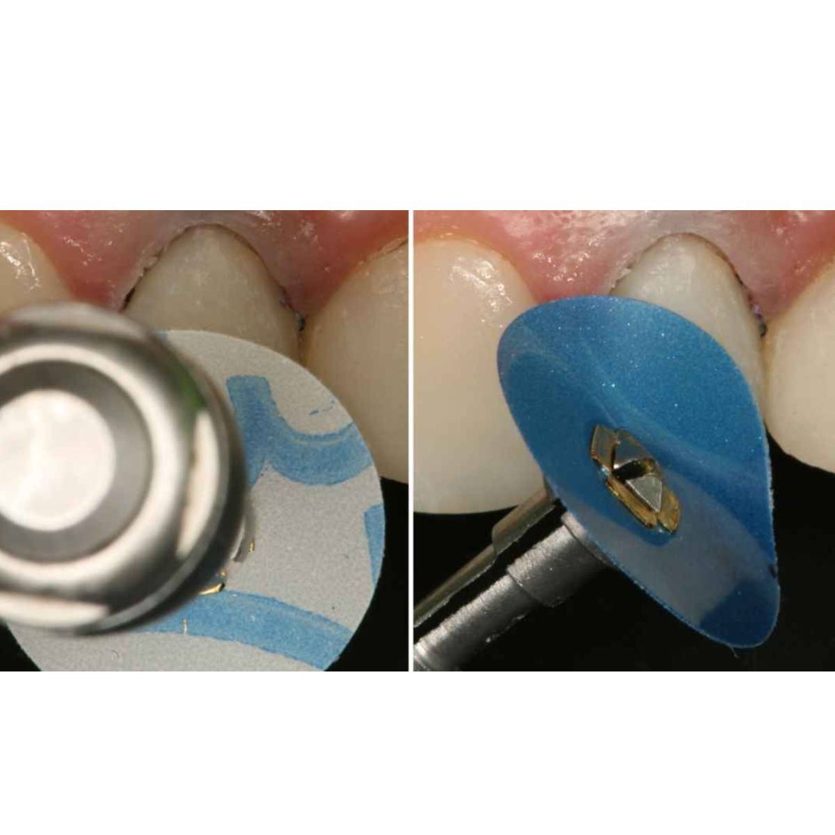 3M ESPE Sof-Lex Mandrel (Pack of 3)