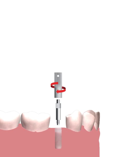 DentalPlant SmartPeg Mount