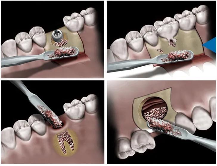 Novabone Dental Morsel - 0.5cc