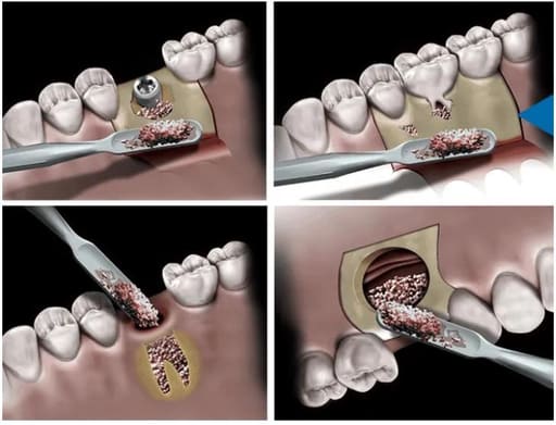 Novabone Dental Morsel - 0.5cc