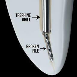 Waldent Trephine Drills For EndoResQ File Retrieval System (Pack Of 3) - 3