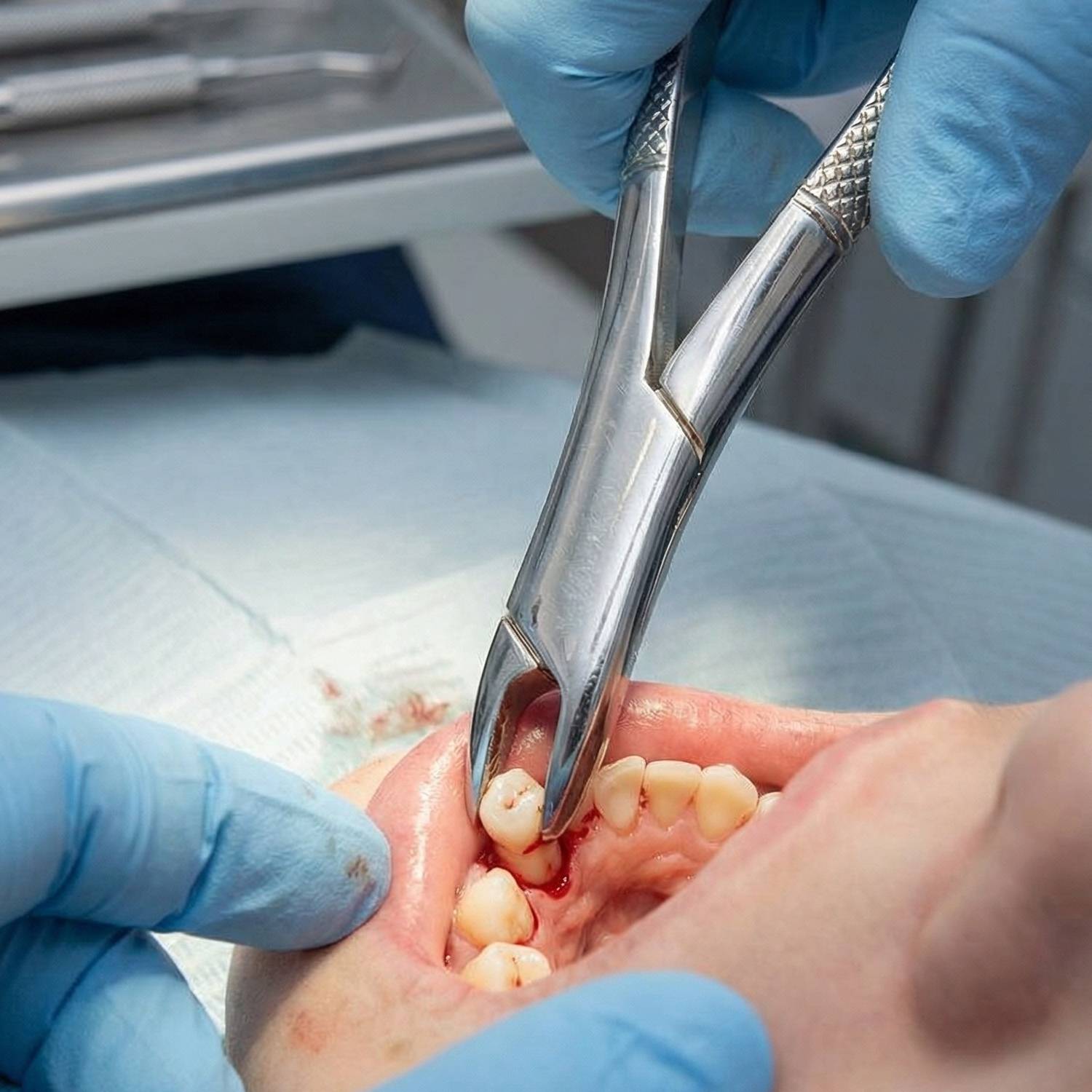 GDC American Forcep Pedo Universal Lower Primary Teeth & Roots # 151S (F151S)