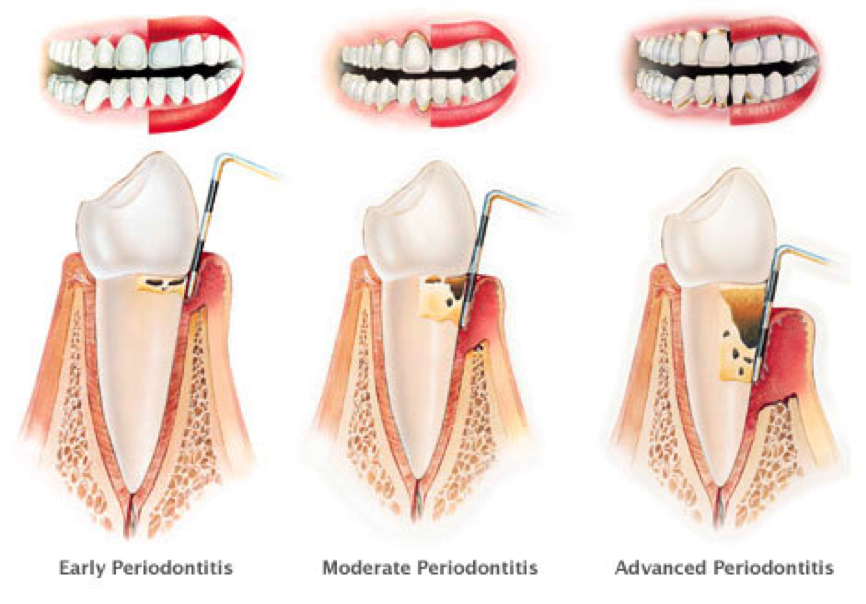 Waldent CPITN - B Probe (15/805)