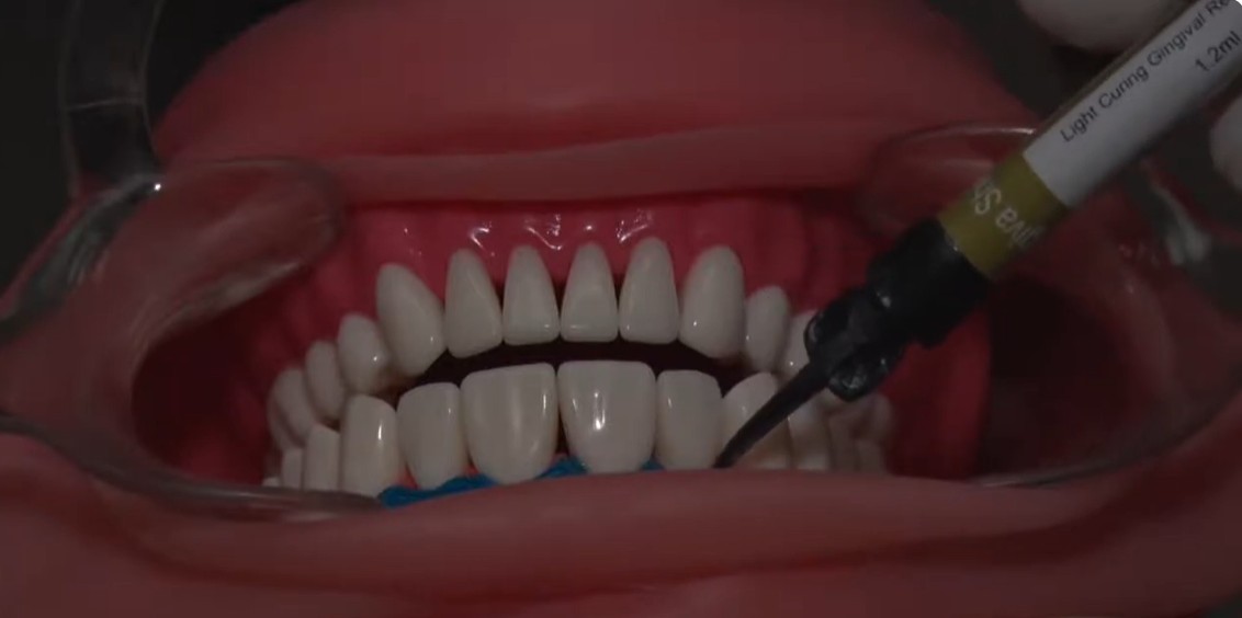 Prevest Florence Teeth Whitening Kit- 1 Patient