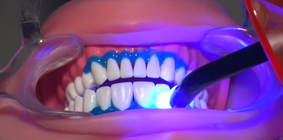 Prevest Florence Teeth Whitening Kit- 1 Patient