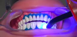 Prevest Florence Teeth Whitening Kit- 1 Patient - 9