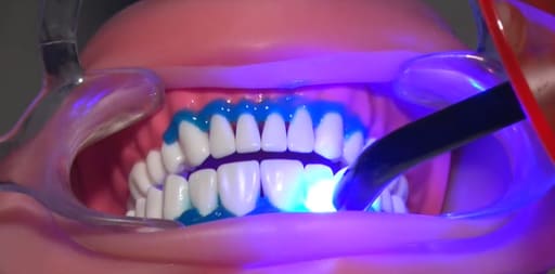 Prevest Florence Teeth Whitening Kit- 1 Patient
