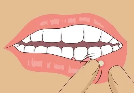 Ortis Triclon Oral Gel