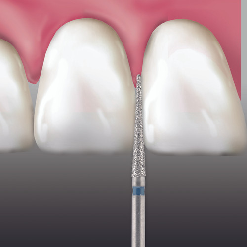 Prima Dental Needle Bur FG (Pack Of 5 Burs) 859 (016)