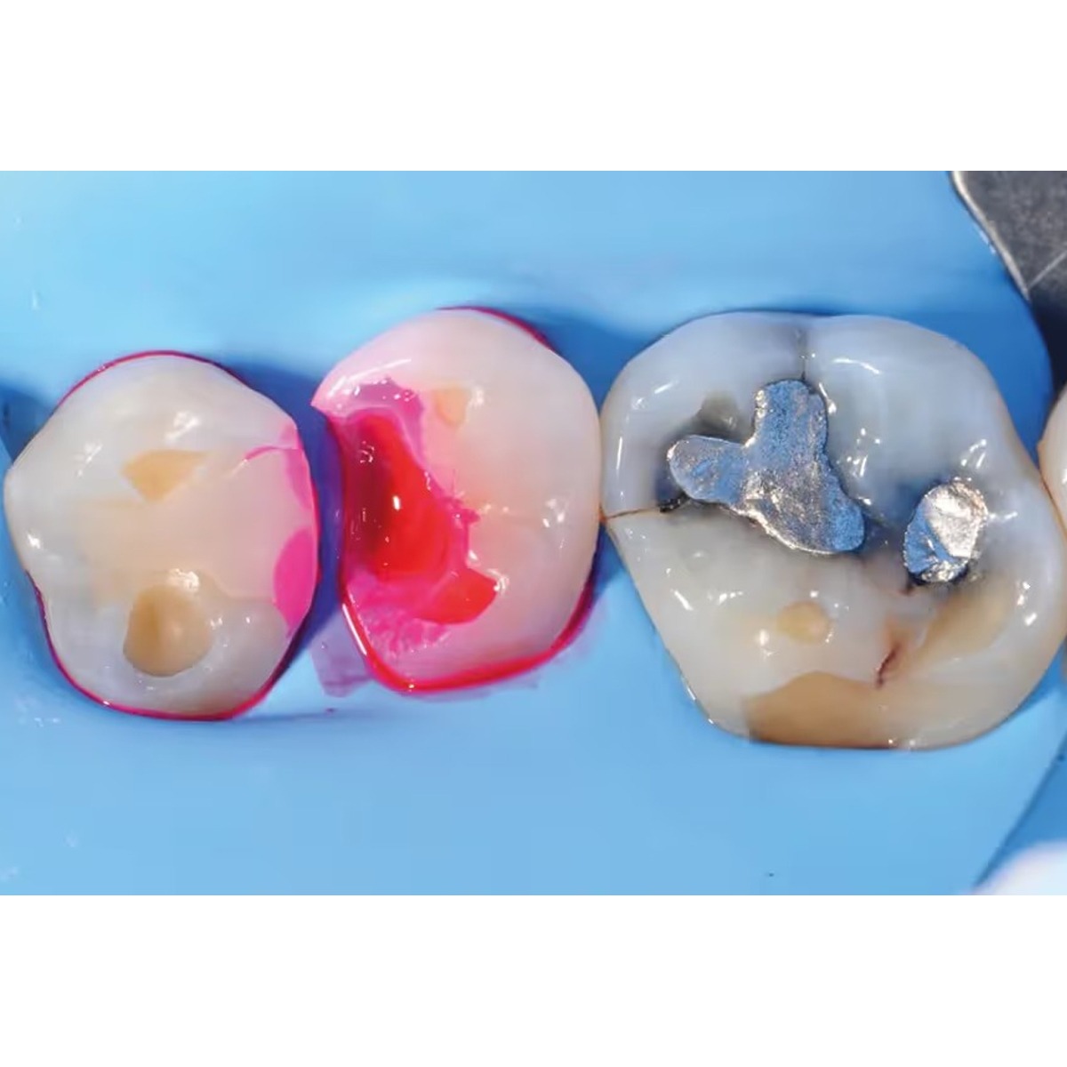 Maarc Find Fast Caries Indicator  (3005/015)