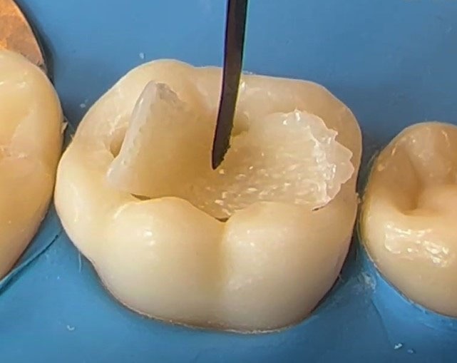 Ribbond Ribbon Fiber Splint