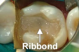 Ribbond Ribbon Fiber Splint - 8