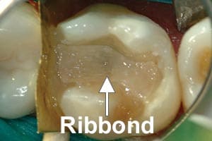 Ribbond Ribbon Fiber Splint