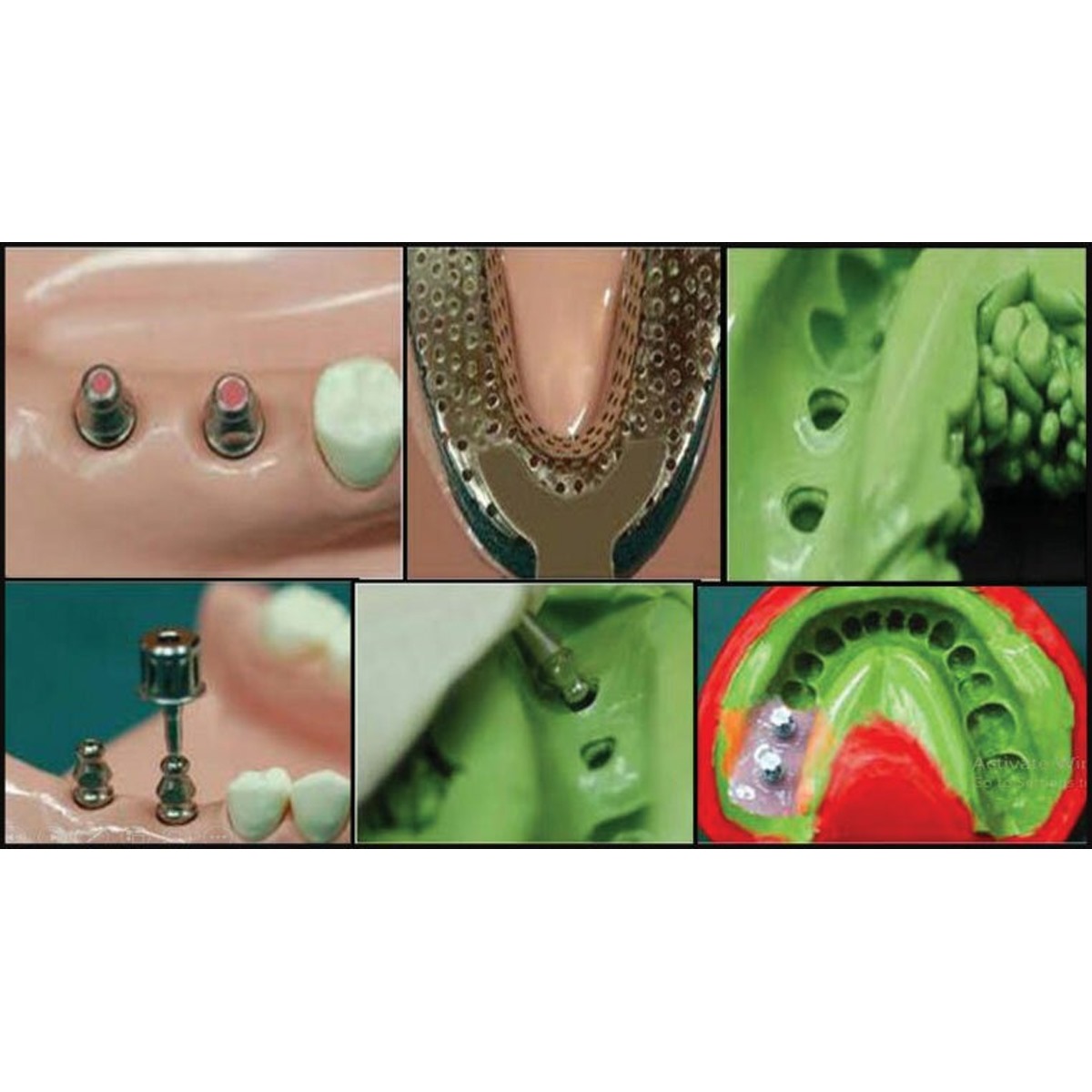 Dentaltech Close Tray Impression Copings - Osstem | Dentium | DIO | Cowellmedi | Neobiotech | Dentis Compatible