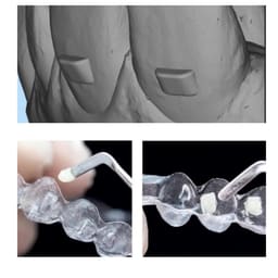 UU Ortho AlignTemplate Foil - Round 0.40 mm | For Composite Attachment Transfer (Pack of 10) (Code no. 121) - 6