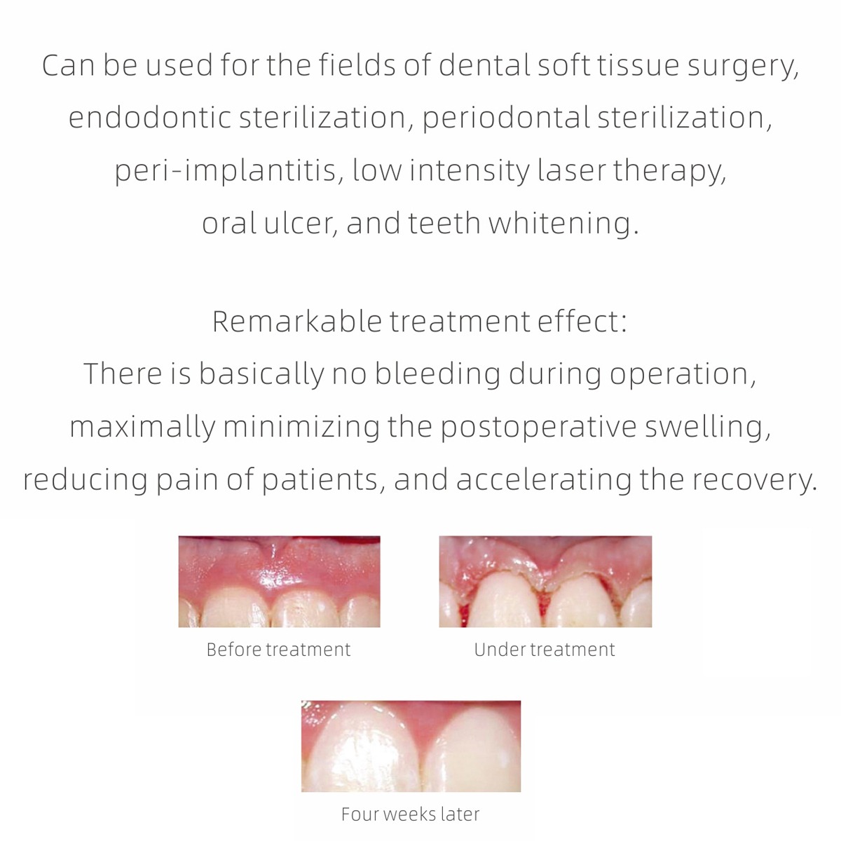 Woodpecker LX16 Plus Dental Diode Laser