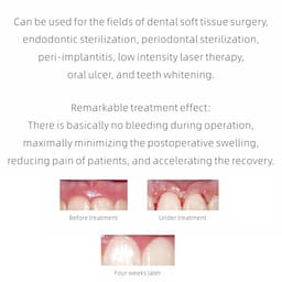 Woodpecker LX16 Plus Dental Diode Laser - 7