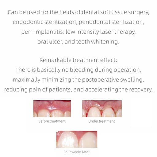 Woodpecker LX16 Plus Dental Diode Laser
