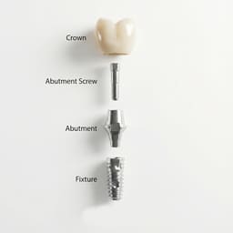 Mediden Nobel Active RP Compatible Titanium Abutment Screw (S-47) - 5